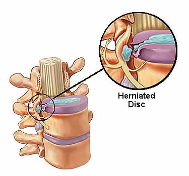 Herniated disc illustration