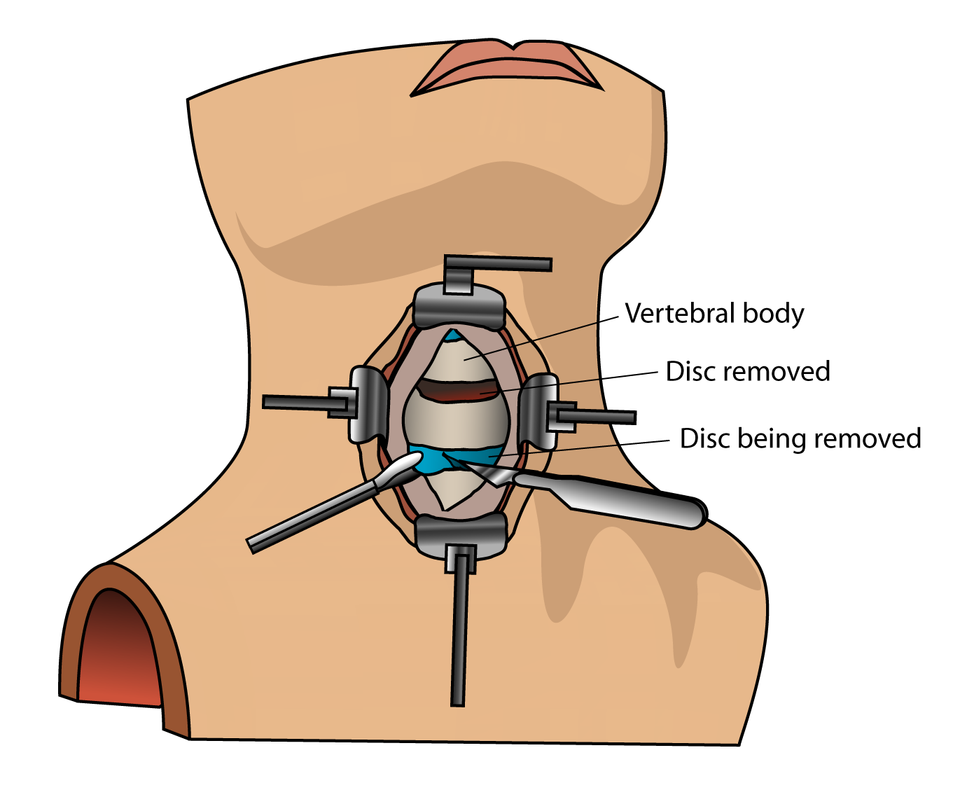 Artificial disc implant